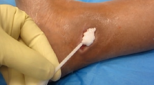 FG blister